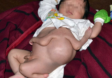 Tây Ninh: Em bé mới sinh có bốn cánh tay